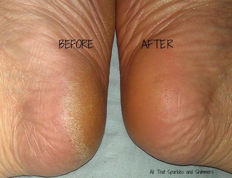 Ped Egg Foot File: Before and After allthatsparklesandshimmers.blogspot.com Pedicure Before And After, Pedicures, Chanel Ballet Flats, Name It, My Husband, Cute Nails, Egg, Nails, Quick Saves