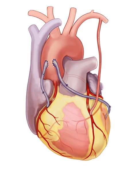 Coronary artery bypass surgery is commonly called as heart bypass surgery. Bypass surgery is a procedure that involves diverting of left internal thoracic artery to the left anterior descending branch of the left main coronary artery for the purpose of retaining normal blood flow. It is expected to relieve dysfunctioning of left ventricle and decrease … Computed Tomography, Spinal Fluid, Coronary Artery, Heart Anatomy, Bypass Surgery, Heart Muscle, Coronary Arteries, Brain Surgery, Heart Surgery