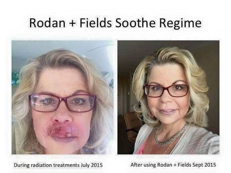 Rodan And Fields Soothe, Rodan And Fields Business, Rodan And Fields Consultant, Life Changing Skincare, Rodan And Fields, Skin Care Regimen, Facial Care, Irritated Skin, Good Skin