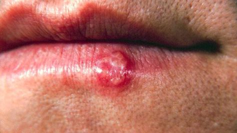 Herpes: Symptoms, Treatments, and Facts Cold Sore Scab, Get Rid Of Cold, Fever Blister, Cold Sores, Canker Sore, Cold Sores Remedies, Cold Sore, Skin Conditions, Type 1