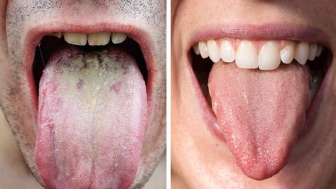 Researchers Explain What The Color of Your Tongue Says About Your Health Yellow Tongue, Healthy Tongue, White Tongue, Sunburn Relief, Coconut Health Benefits, Tongue Health, Nail Care Tips, Benefits Of Coconut Oil, Nail Health