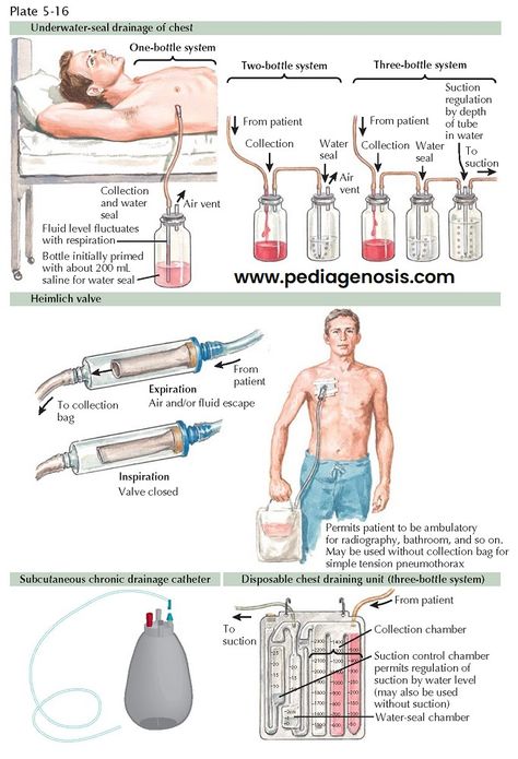 Chest Tube Drainage System, Respiratory Therapist Student, Medical Things, Chest Tube, Pleural Effusion, Critical Care Nursing, Med Surg, Drainage System, Respiratory Therapist