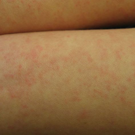 How to Identify Hives vs. Other Skin Rashes: Hives Caused by Infection Skin Rashes Pictures, Hives Causes, Hives Rash, Types Of Skin Rashes, Leg Rash, Allergy Rash, Types Of Rashes, Rashes Remedies, Rash Causes