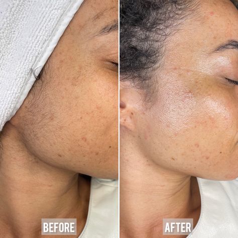 Esthetician Before And After, Before And After Dermaplaning, Dermaplane Facial Before And After, Dermaplaning Facial Steps, Before After Skincare, Dermaplaning After Care, Dermaplaning Before And After, Girl Esthetics, Before And After Skincare