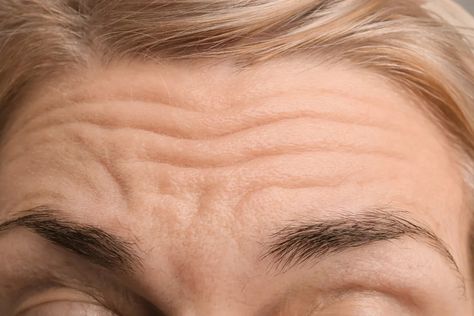 How to Get Rid of Forehead Wrinkles: 18 Dermatologist-Approved Tips Prevent Forehead Wrinkles, Get Rid Of Forehead Wrinkles, Reverse Wrinkles, Face Lift Tape, Fractional Laser, Aging Beauty, Eliminate Wrinkles, Buy Skincare, Facial Wrinkles