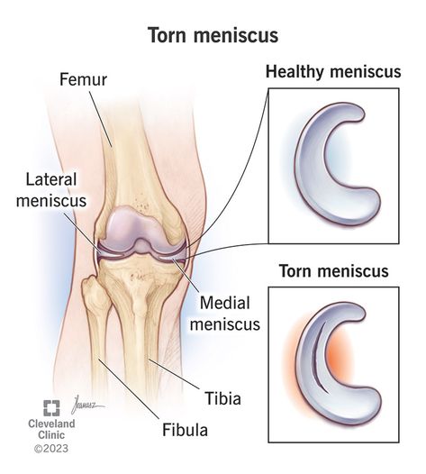 What Is a Torn Meniscus? Medial Meniscus, Common Knee Injuries, Meniscus Surgery, Knee Meniscus, Meniscal Tear, Knee Problem, Ligament Tear, Nursing School Notes, Orthopedic Surgery