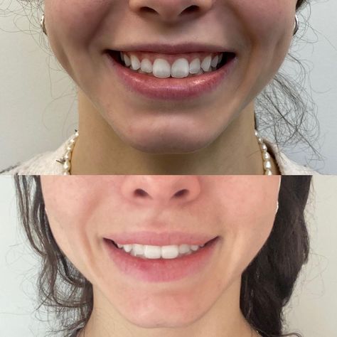 Lip Flip Before And After, Lip Flip Botox Before And After, Lip Flip, Botox Before And After, Lip Filler, Cosmetic Treatments, Lip Shapes, Cosmetic Procedures, Upper Lip