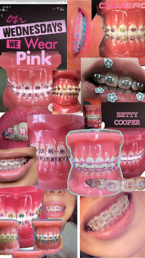 Summer vibes ☀️🦋🩷 Power Chain Braces, Dental Braces Colors, Pink Braces, Braces And Glasses, Cute Braces Colors, Pretty Teeth, Creative Snaps For Snapchat, Grillz Teeth, Braces Tips