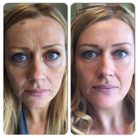 Eye Filler, Gina Jones, Liquid Facelift, Botox Before And After, Tear Trough, Facial Fillers, Teeth Bleaching, Fine Wrinkles, Botox Fillers