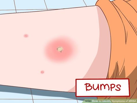 How to Identify Symptoms of MRSA: 13 Steps (with Pictures) Infected Bug Bite, Spider Bite Symptoms, Diseases Pictures, Bug Bites Remedies, Spider Bites, Natural Healing Remedies, Infection Control, Simple Health, Skin Diseases