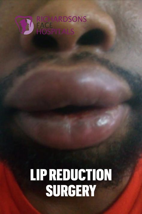 Lip Reduction Surgery of a patient from Ghana in Richardsons Face Hospitals, Tamil Nadu, INDIA.  We take care of your face like no one else!! Lip Reduction, Lip Surgery, Reduction Surgery, Facial Plastic, Plastic Surgeon, Tamil Nadu, Pink Lips, Take Care Of Yourself, Ghana