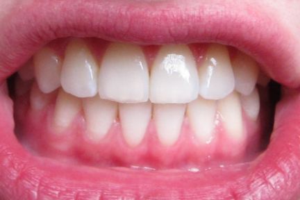 Say Braces!: Before and After Braces—Braces Off, Underbite Fixed ... Teeth After Braces, Braces Before And After, Mouth Anatomy, After Braces, Adult Braces, Braces Off, Beautiful Teeth, Straight Teeth, Teeth Braces