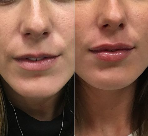 #lipspiration from these luscious lips, injected in October. Notice how the added fullness in her top lip gives her lips more balance and helps to removes the appearance of lines in the bottom lip 💋 Lip Filler On Small Lips, Full Lips Makeup, Lips Fillers, Lip Flip, Lip Lift, Lips Inspiration, Botox Lips, Facial Fillers, Small Lips