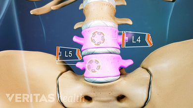 Due to its load-bearing function, the L4-L5 spinal motion segment may be susceptible to injury and/or degenerative changes. Knots In Neck Muscle, Lumbar Exercises, Spinal Degeneration, Sciatic Nerve Pain Relief, Spine Pain, Spinal Decompression, Spinal Fusion, Spinal Surgery, Degenerative Disease