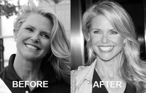 Christie Brinkley Plastic Surgery Photo Christie Brinkley Plastic Surgery, Christie Brinkley Hair, Christy Brinkley, Christie Brinkley Style, Korean Plastic Surgery, Plastic Surgery Photos, Bottle Blonde, 2023 Hair, Celebrity Plastic Surgery