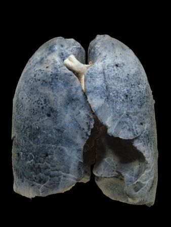 Smoker Lungs - R Hutchings Smokers Lungs, Lungs Art, Human Body Projects, Lung Anatomy, Human Lungs, Lung Transplant, Evidence Based Medicine, Nurse Rock, Homemade Laundry