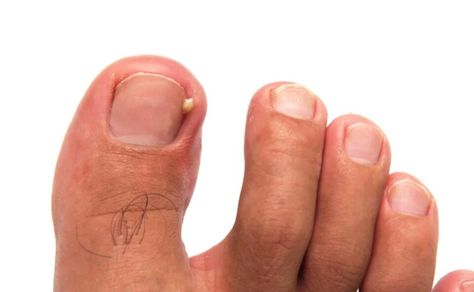 Learn about the common and bothersome issue of ingrown toenails. Learn about their causes, at-home remedies, and the crucial signs that indicate it's time to seek professional intervention. Learn everything you need to know about Ingrown toenails in our article below! #IngrownToenail #FootHealth #FeetFirstClinic #TorontoHealth Toenail Pain, Toenail Problems, Nail Problems, Nail Infection, Ingrown Toenail, Shaving Tips, Ingrown Nail, Hard Nails, Brittle Nails