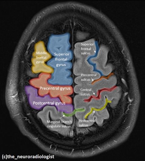 Mri Anatomy, Brain Anatomy And Function, Brain Mri, Medical Radiography, Mri Brain, Radiology Student, Medical Mnemonics, Radiology Imaging, Medicine Studies