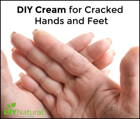 This DIY cream for cracked hands and feet uses a luxurious blend of herbs and oils. Use it to help get rid of dry, cracked winter skin on hands and feet. Cracked Fingers, Natural Homemade Soap, Dry Cracked Hands, Chapped Hands, Diy Cream, Cracked Hands, Hand Moisturizer, Dry Skin Remedies, Skin Care Wrinkles