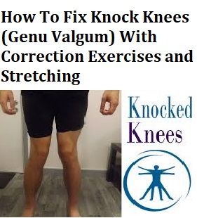 Fix Knock Knees, Knocked Knees, Knee Pain Remedies, Knock Knees Correction, Genu Valgum, Knee Pain Remedy, Knock Knees, Knee Stretches, Get Shredded