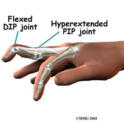 Swan-neck deformity Nbcot Exam Prep, Forearm Bones, Nbcot Exam, Finger Injury, Finger Splint, Therapist Office, Swan Neck, Patient Education, Strengthening Exercises