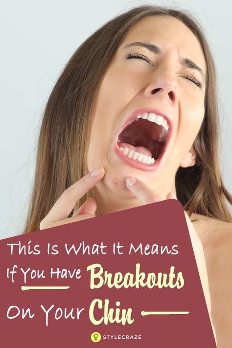 Do You Have Regular Breakouts On Your Chin? Here's What It Really Means Acne On Chin Meaning, Chin Pimples Meaning, Chin Breakouts, Zit Remedy, Painful Acne, Big Pimple, Back Acne Remedies, Banana Diet, Big Pores