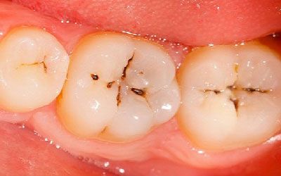 Home Remedies To Get Rid Of Tooth Decay Cavity Remedy, Tooth Cavity, Heal Cavities, Dental Cavities, Tooth Extraction, Receding Gums, Tooth Decay, Health Advice, Oral Health