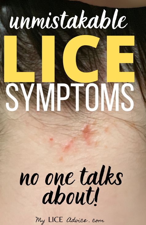 Discover 17 common head lice symptoms with pictures and find out the early and late signs of lice and use these fool-proof ways to figure out whether or not you have lice. Hairstyles To Prevent Lice, Lice Hairstyles, Head Itching Remedies, Natural Remedies For Lice, Lice Remedies How To Get Rid Of, Lice Spray For Furniture, How To Prevent Lice, Lice In Hair, Lice Pictures