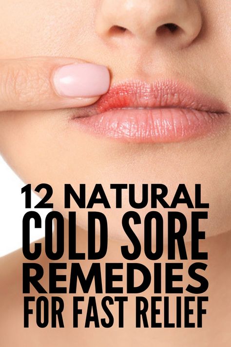 Fever Blister Remedy, Blister Remedies, Cold Sore Remedies, Blister On Lip, Natural Cold Sore Remedy, Fever Blister, Cold Sores Remedies, Brown Spots On Face, Spots On Face