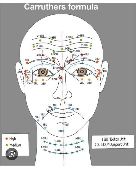 Botox Injection Sites, Dermal Fillers Lips, Injection Sites, Facial Injections, Botox Injection, Botox Before And After, Facial Anatomy, Botulinum Toxin, Facial Fillers