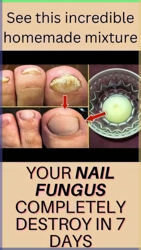 Discover effective methods to use hydrogen peroxide for treating nail fungus. Learn tips and techniques to restore healthy nails with this simple solution. Nail Infection, Nail Fungus Remedy, Fungal Nail, Nails Today, Nail Care Routine, Brittle Nails, Toenail Fungus, Fungal Infection, Nail Fungus