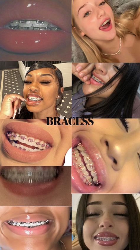 Braces Dental Braces Colors, Pretty Eyes Color, After Braces, Cute Braces Colors, Teeth Aesthetic, Pretty Teeth, Braces Tips, Getting Braces, Cute Braces