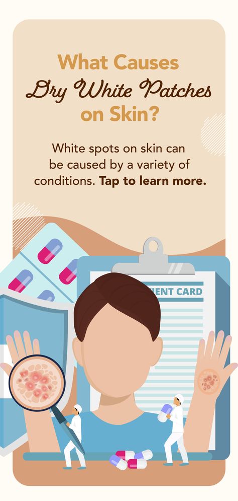 Finding strange white spots on your skin? You could be missing key elements in your diet, or you may have one of these common conditions: #psoriasis, #eczema or #SeborrheicDermatitis, also known as #dandruff. Click to learn everything you need to know and download a free guide. #scrippshealth #skincare #skinissues #whitepatchesonskin #whitespotsonskin #dryskin #whydoihavewhitespotsonmyskin #whydoihavewhitepatchesonmyskin #skincaretips #skincareissues #dandrufftreatment #eczematreatment White Skin Patches, White Skin Spots, Skin Patches, Skin Spots, Nutritional Deficiencies, Skin Disorders, White Patches, Skin Discoloration, Skin Issues