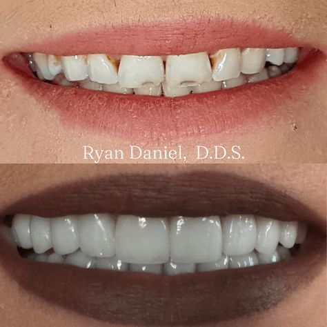 Cosmetic bonding and dental veneers are only two of the procedures that can be used to make teeth seem better. We will contrast these two treatments in this post to make it easier for you to decide which could be best for you. Cosmetic Bonding Teeth, Composite Veneers Before And After, Teeth Bonding Before And After, Composite Bonding Teeth, Cosmetic Bonding, Teeth Bonding, Composite Bonding, Composite Veneers, Dental Bonding