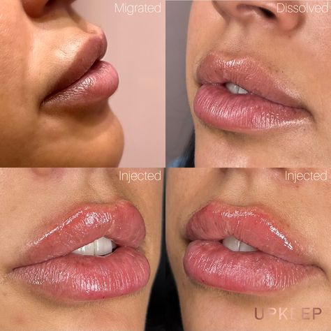 Lip filler before and afters by UPKEEP Med Spa. Lip Filler migration is caused by over filling lips and can be reversed by having a professional dissolve lip filler. Find more juicy lip inspo and beauty aesthetics on our page or Instagram. Full Lips Makeup, Lips Inspiration, Facial Contouring, Botox Fillers, Honey Brown Hair, Full Lips, Lip Injections, Juicy Lips, Lip Fillers