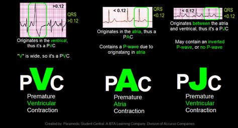 Paramedic Student Central: PVC, PAC, PJC Quick Reference Tool Emt Study, Paramedic Student, Cardiology Nursing, Paramedic School, Nursing School Prerequisites, Nurse Study Notes, Cardiac Nursing, Pharmacology Nursing, Nursing School Survival