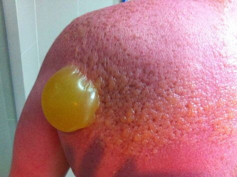 Severe sun burn Sunburn Blisters, How To Treat Sunburn, Bad Sunburn, Skin Cream Anti Aging, Sun Burn, Wear Sunscreen, Sun Damage, Beauty Standards, Best Anti Aging