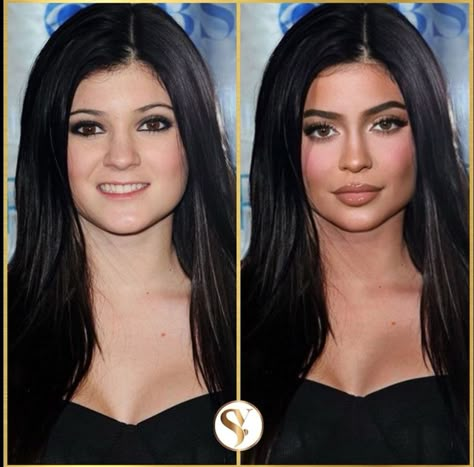 Kendall Jenner Before And After Surgery, Facial Plastic Surgery Before After, Kylie Before And After Surgery, Kylie Jenner Before And After, Celebrity Plastic Surgery Before After, Kylie Before And After, Kendall Jenner Kylie Jenner, Aesthetic Procedures, Celebrity Surgery