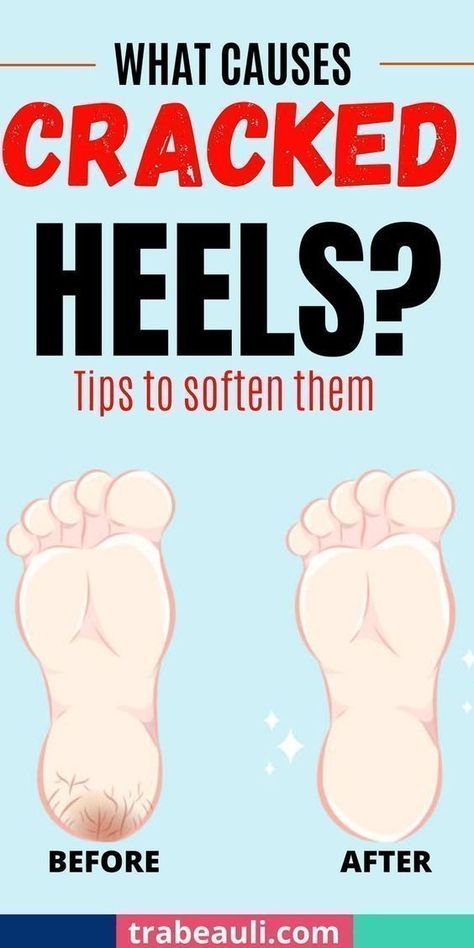 Homemade foot cream, heel recovery cream How To Heal Cracked Feet Fast, Diy Cracked Heel Remedy, Peeling Feet Causes, How To Keep Feet Soft, Smooth Feet Remedies, Peeling Feet Remedy, Cracked Heels Remedy Overnight, Dry Feet Remedies Overnight, Cracked Heel Remedy