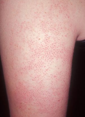 Nasty bumps on the back of your arms? Skin Bumps On Arms, Bumps On Arms, Keratosis Pilaris Remedy, Patchy Skin, Nail Problems, Skin Bumps, Skin Care Guide, Keratosis Pilaris, Bumpy Skin