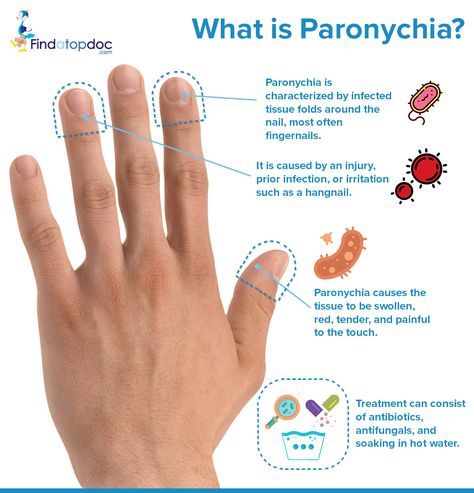 What is Paronychia? Finger Infection, Nail Disorders, Nail Conditions, Nail Problems, Nail Infection, Ingrown Toe Nail, Nail Health, Natural Home Remedies, Medicinal Herbs