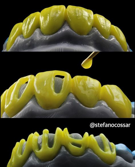 Wax Up Dental Teeth, Exocad Dental, Dental Assistant Study, Dental Videos, Dental Anatomy, Dental Fun, Aesthetic Dentistry, Dental Technician, Dental Marketing