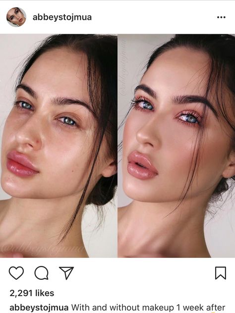 Lip goals...Lip fillers Lip Injections Juvederm, Lip Goals, Botox Lips, Beauty Formulas, Facial Plastic Surgery, Lip Filler, Facial Plastic, Lip Shapes, Lip Injections