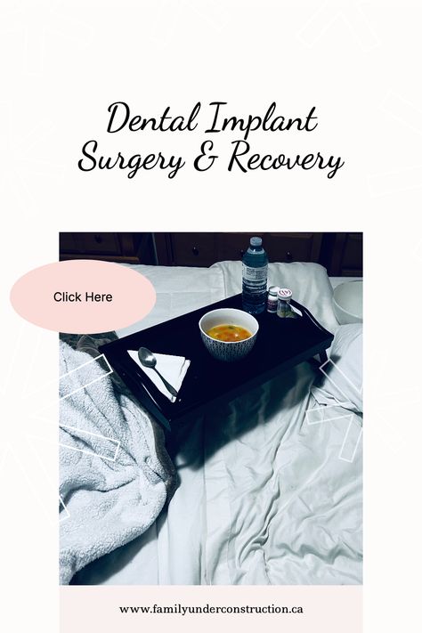 Follow me on my dental implant adventure. It isn't easy, it isn't cheap, but it is 100% worth it in the end! Read about the surgery, recovery, what to eat, what to expect, and the frustrations I went through. . . #dentalimplants #dentist #dentistry #dental #smile #teeth #cosmeticdentistry #dentalcare #implants #oralsurgery #oralhealth #orthodontics #smilemakeover #smiledesign #implantdentistry #braces #dentalsurgery #hollywoodsmile #dentalimplantsurgery Dental Surgery Recovery, Tonsils And Adenoids, Clear Retainers, Dental Smile, Adult Braces, Cleft Lip And Palate, Kids Braces, Dental Implant Surgery, Bone Grafting