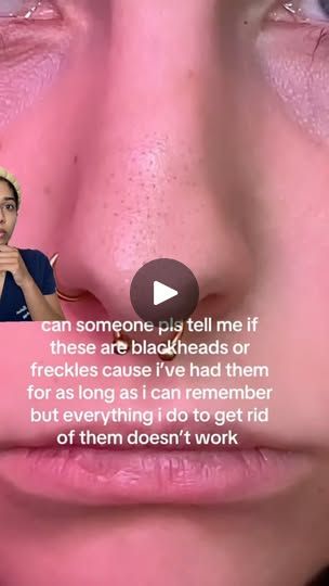 Sebaceous Filaments, Facebook Face, Salicylic Acid Cleanser, Healthy Hacks, Face Tips, Pore Strips, Beauty Remedies, Unclog Pores, Skin Routine