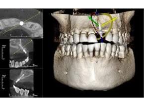 New Study on Dental CBCT   Industry 2021 Forecast Report @ http://www.orbisresearch.com/reports/index/global-dental-cbct-market-trend-and-forecast-to-2021 Cbct Dental, Dental Implant Surgery, Dental Center, Family Dentistry, Dental Surgery, Paradigm Shift, Research Report, Dental Practice, Radiology