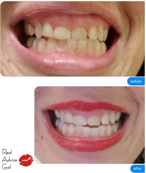 Do you want to have whiter teeth? Do you want to have that confidence to smile without worrying about your stained teeth? Read my secret on How to Whiten Your Teeth Without the Dentist Real Advice, Dental Cavities, Whiten Your Teeth, Whiter Teeth, Brush My Teeth, Stained Teeth, The Dentist, Whitening Toothpaste, Tea Stains