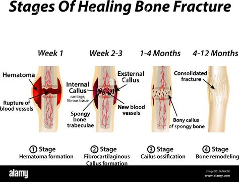 Download this stock vector: Stages Of Healing Bone Fracture. Formation of callus. The bone fracture. Infographics. Vector illustration on isolated background. - 2APGK5R from Alamy's library of millions of high resolution stock photos, illustrations and vectors. Stages Of Healing, Fracture Healing, Bone Healing, Bone Fracture, The Bone, Blood Vessels, Bones, Stock Vector, Vector Illustration