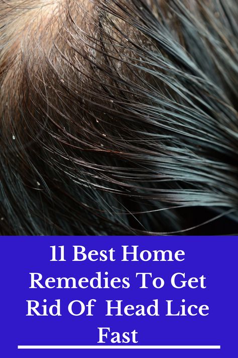 11 Best Home Remedies To Get Rid Of Head Lice Fast Getting Rid Of Nits, Lice Nits, Lice Remedies, Hair Lice, Head Louse, Dark Eye Circles, Fast Hair, Fast Hairstyles, Hair Care Tips