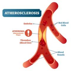 Types of heart disease collection, vector illustration diagram. Educational medical information. Stock Vector | Adobe Stock Circulatory System Diseases, Healthcare Illustration, Medical Vector, Medical Facts, Human Body Systems, Science Notes, Medical Anatomy, Circulatory System, Red Blood Cells